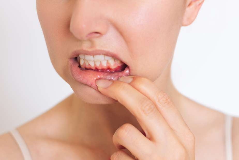 Parodontite: bastano sette giorni per modificare il microbioma orale? parodontite